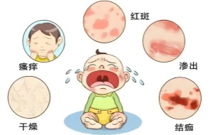 孩子脾虚湿盛、湿疹缠绵？中医有招，助您告别反复困扰！